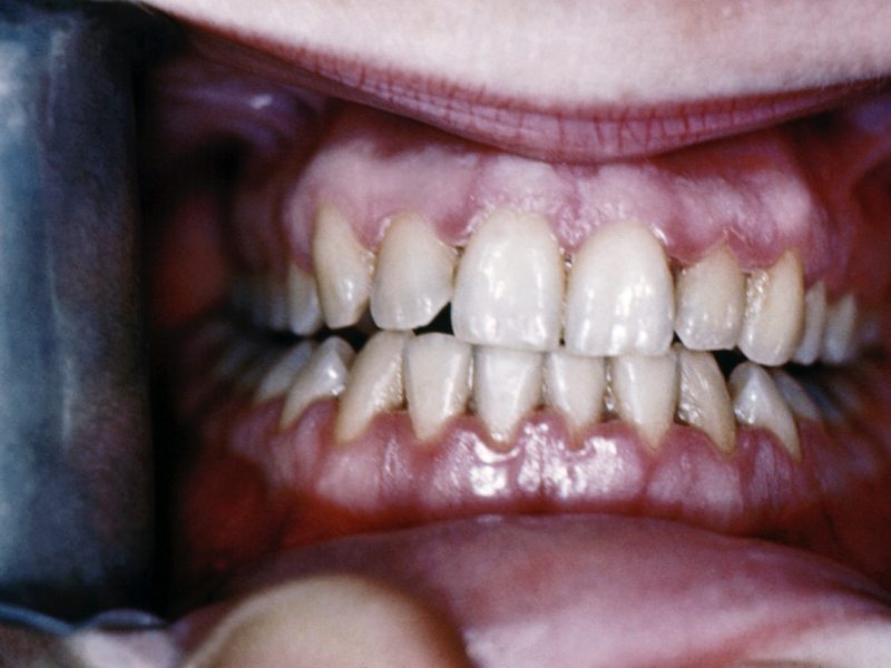 如何照顧糖尿病患的口腔問題